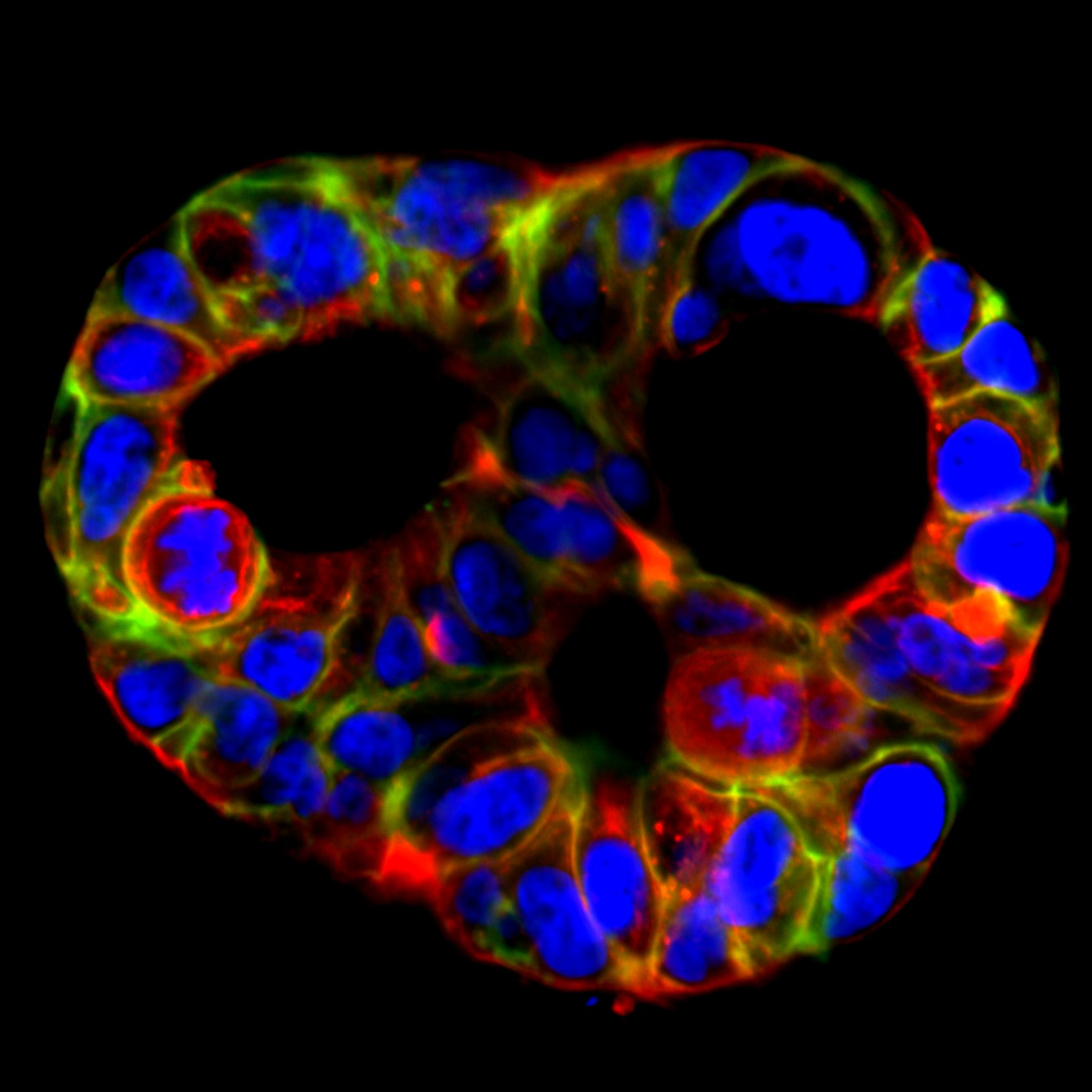 ‘Three-eyed’ Pancreatic Cancer Organoid